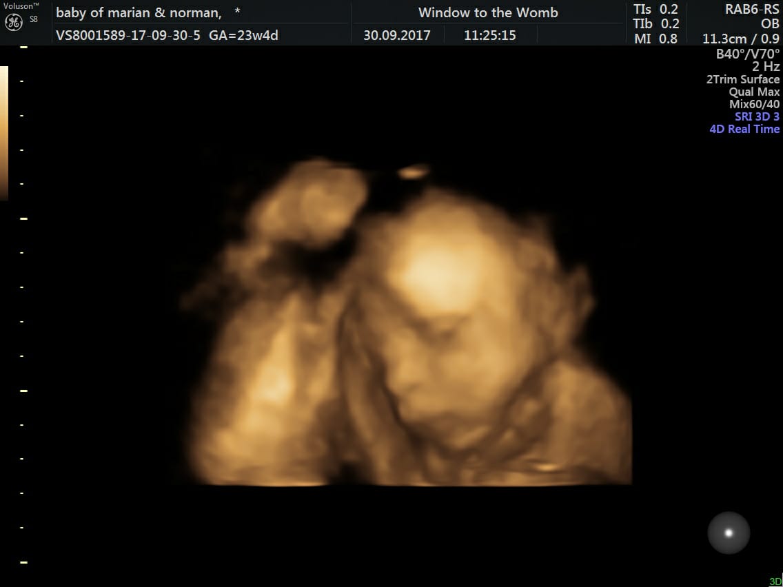 Amazing Story of Baby Jack; Born With One Hand Window to the Womb Window to the Womb